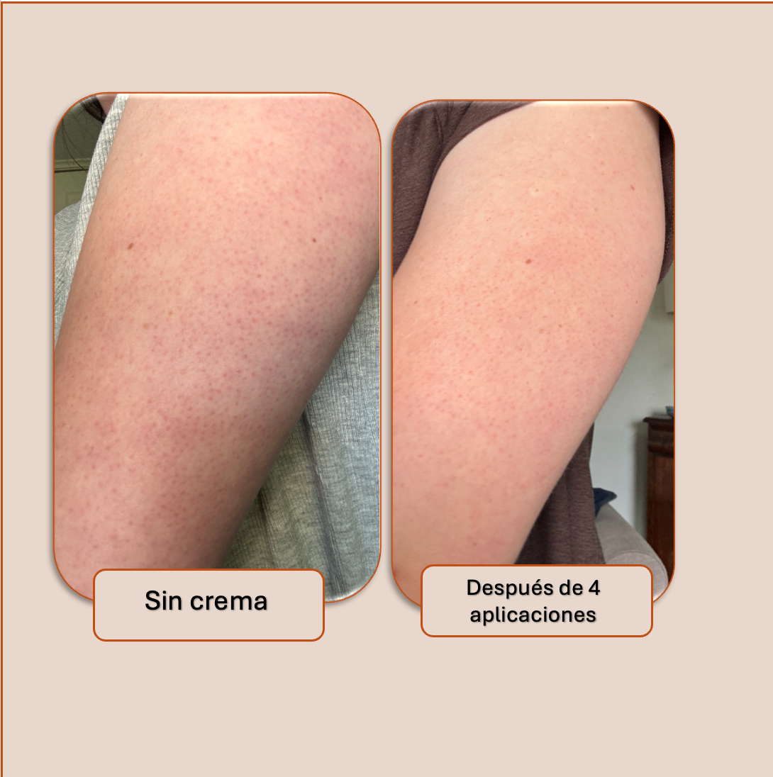 Tersa — Crema corporal multiácida