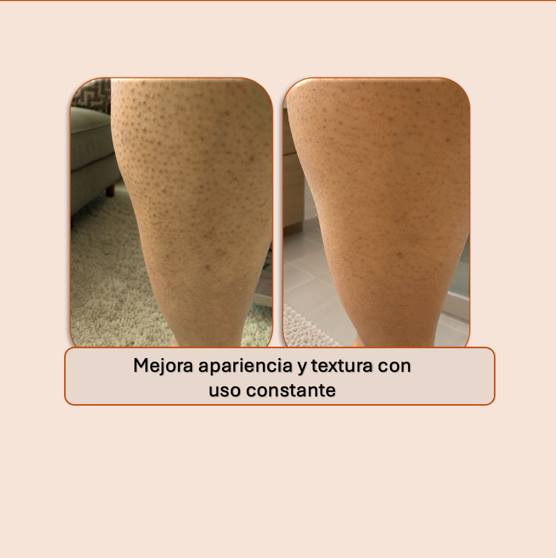Tersa — Crema corporal multiácida